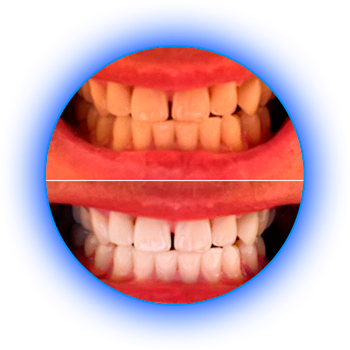 Результаты до и после: Мужчина. 42 г. - 1 процедура, 30 мин.