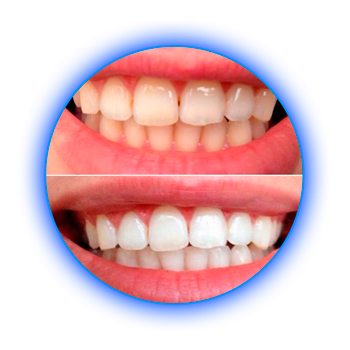 Результаты до и после: Женщина. 38 л. - 2 процедуры, по 30 мин.