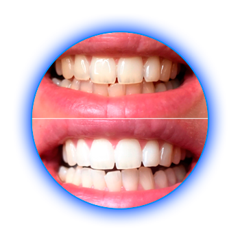 Результаты до и после: Женщина. 36 л. - 3 процедуры, по 30 мин.