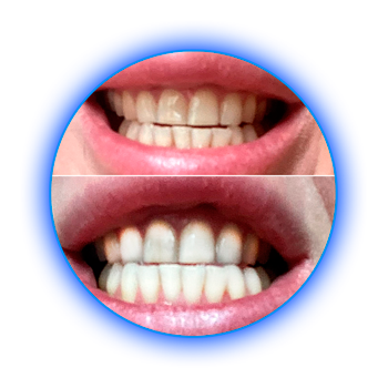 Результаты до и после: Женщина. 34 г. - 1 процедура, 30 мин.